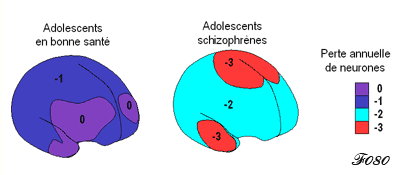 perte neuronale chez les schizophrènes