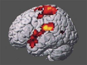 Cerveau : aires de perception de la douleur