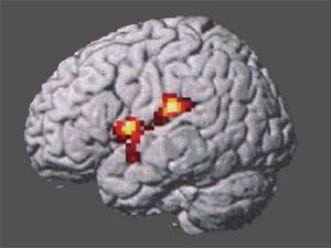 Brain: areas of perception of the pain of others