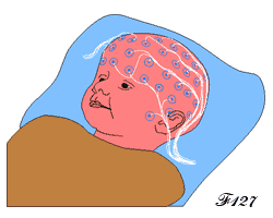Baby under electroencephalogram.