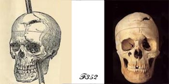 Phineas Gage.